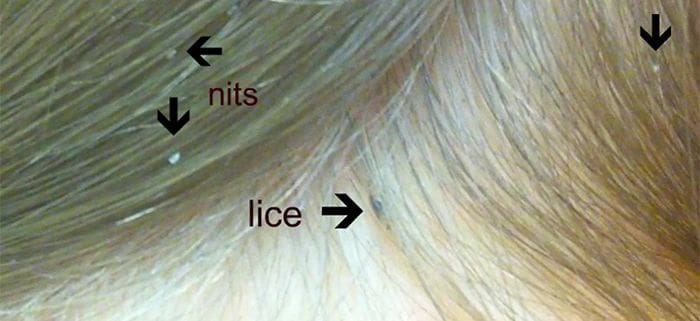 Most Popular Methods For Identifying Lice Nits
