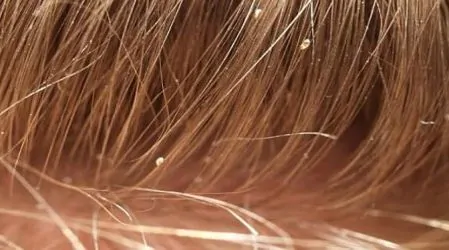 Most Popular Methods For Identifying Lice Nits