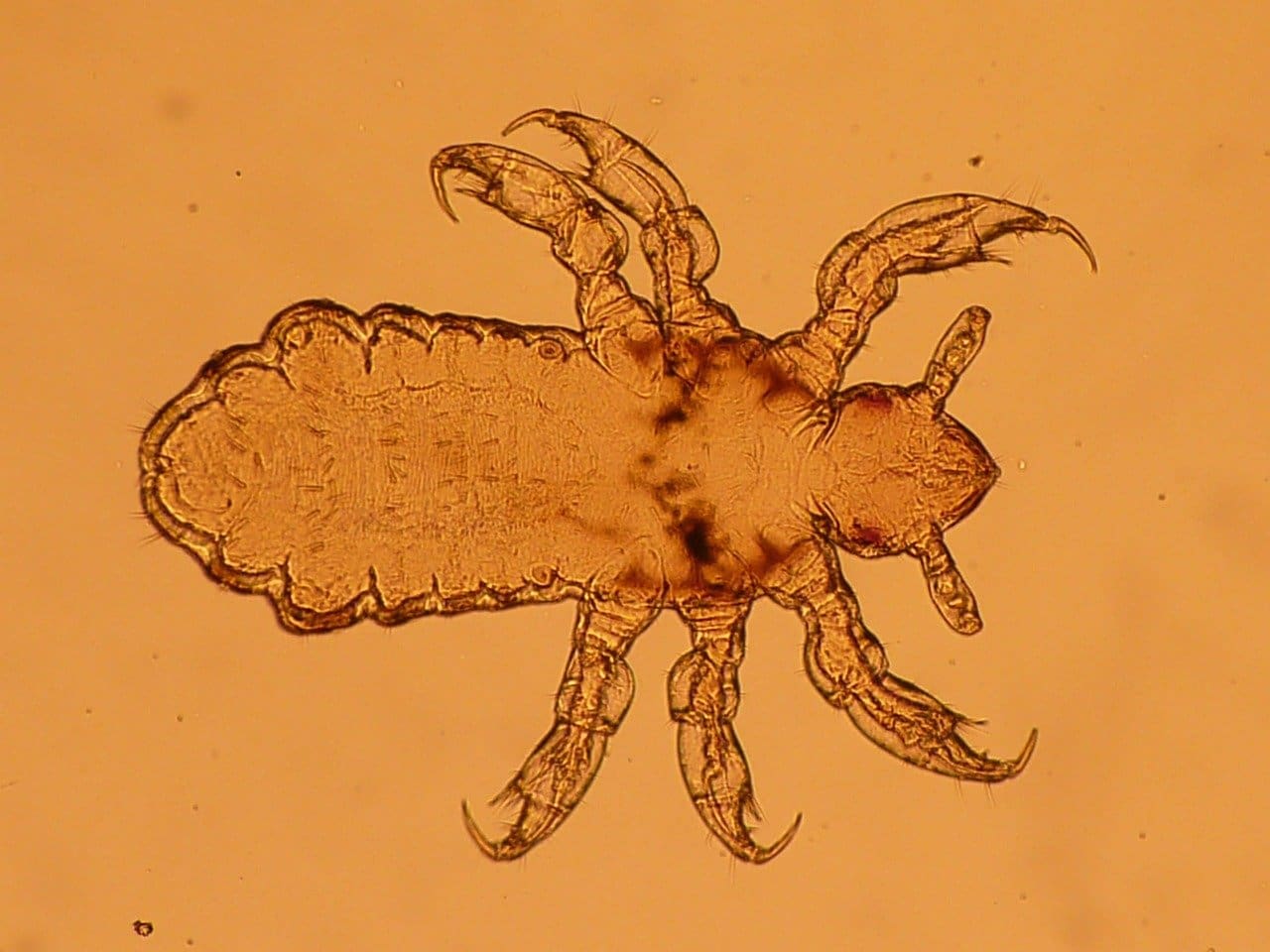 Comparing Prescription Vs. Over-the-Counter Lice Treatments